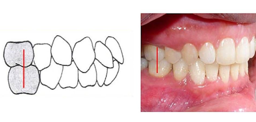 Sau niềng răng không khớp được hàm: Biến chứng tiềm ẩn phá hủy hệ thống nhai