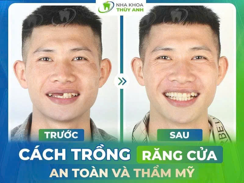 Trồng răng cửa bằng cách nào an toàn và hiệu quả cao?