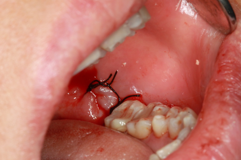 Giai đoạn nào là đau nhất trong một cuộc nhổ răng? Nha khoa Thùy Anh