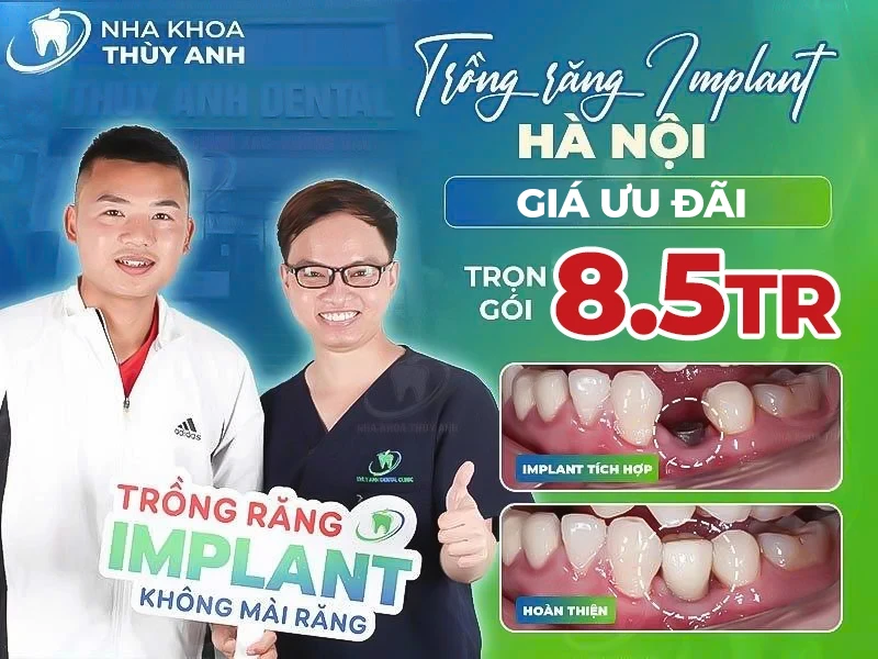 Trồng răng implant Hà Nội giá tốt cập nhật năm 2026