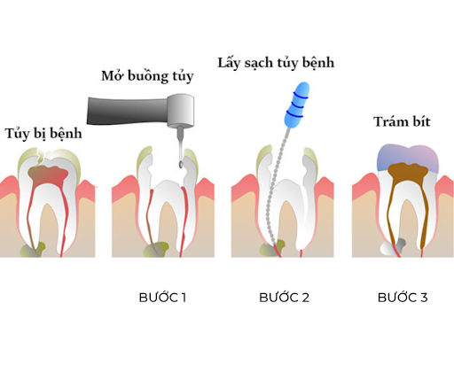 Lấy tủy răng bằng máy khác lấy tủy răng cổ điển như thế nào? Nha khoa Thùy Anh