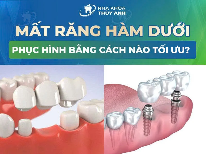 Mất răng hàm dưới phục hình bằng cách nào tối ưu?
