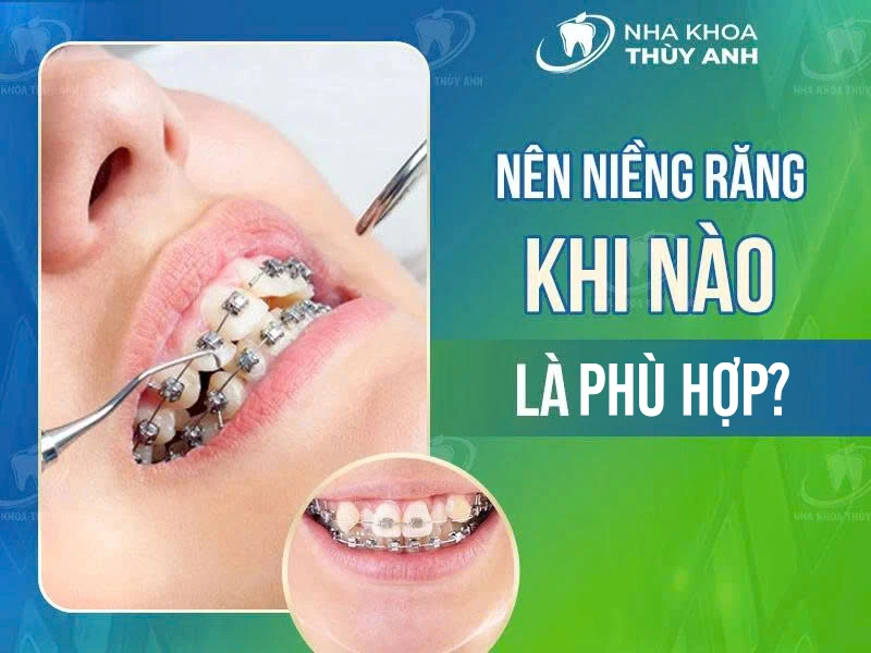 Nên niềng răng khi nào là phù hợp? Thời điểm vàng niềng răng