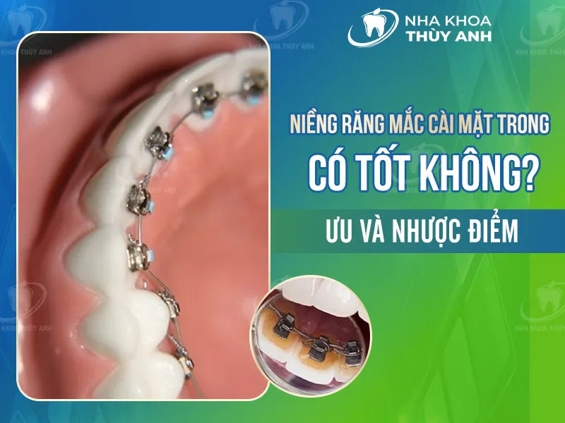 Niềng răng mắc cài mặt trong có tốt không? Ưu và nhược điểm