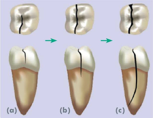 Nứt vỡ răng: Nguyên nhân và phân loại  – nha khoa Thùy Anh