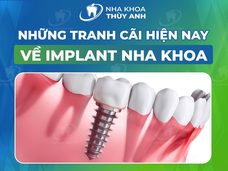 Những tranh cãi hiện nay về Implant nha khoa: Đâu là giới hạn?