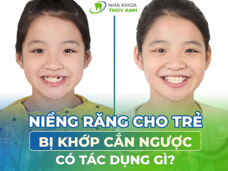 Niềng răng cho trẻ bị khớp cắn ngược có tác dụng gì?