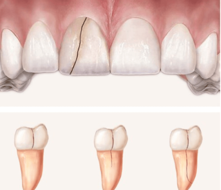 Nứt vỡ răng: Các triệu chứng và phương án điều trị – nha khoa Thùy Anh