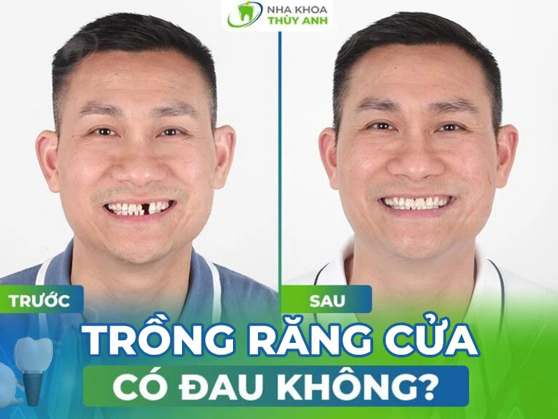 Trồng răng cửa có đau không?