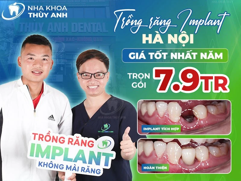 Trồng răng implant Hà Nội giá tốt nhất năm 2025
