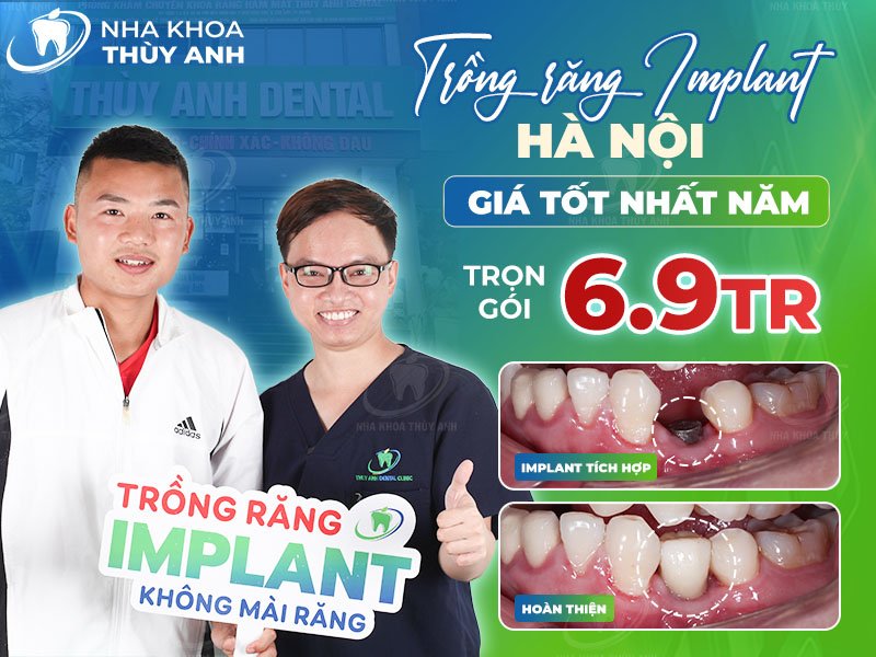 Trồng răng implant Hà Nội giá tốt nhất năm 2024