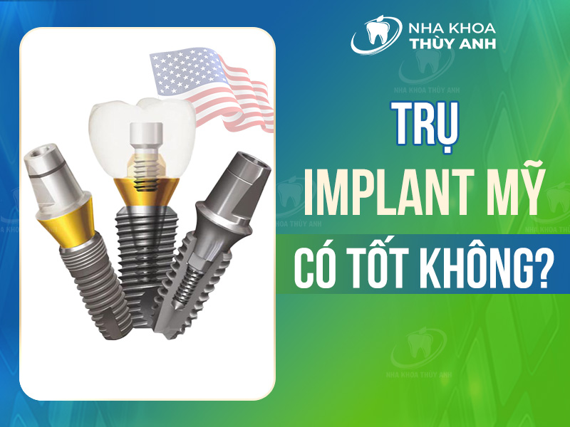 Trụ implant Mỹ có tốt không? Giá trụ implant Mỹ là bao nhiêu?