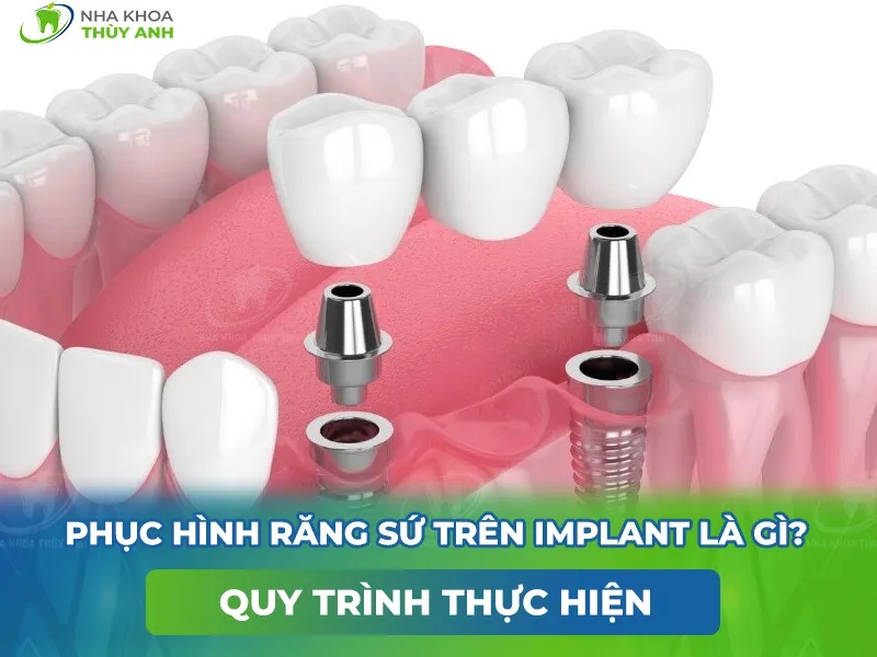 Phục hình răng sứ trên implant là gì? Quy trình thực hiện