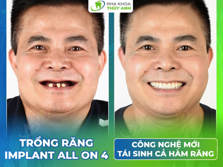 Trồng răng implant all on 4 công nghệ mới tái sinh cả hàm răng