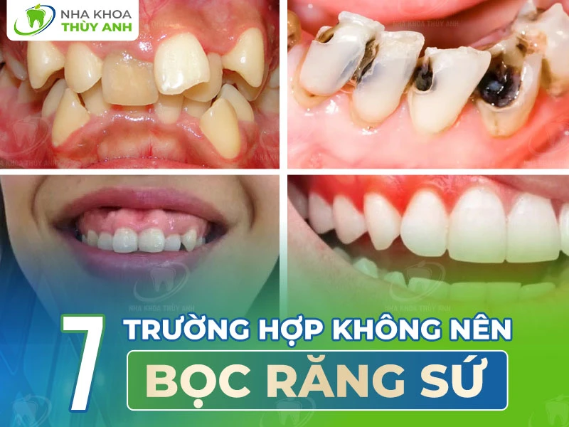 7 trường hợp không nên bọc răng sứ