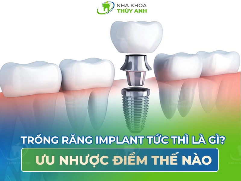 Trồng răng implant tức thì là gì? Ưu điểm như thế nào?