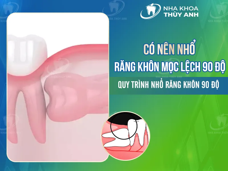 Có nên nhổ răng khôn mọc lệch 90 độ? Quy trình nhổ răng khôn 90 độ