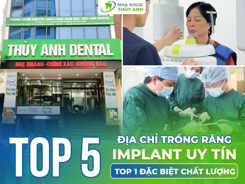Top 5 địa chỉ trồng răng implant uy tín tại Hà Nội