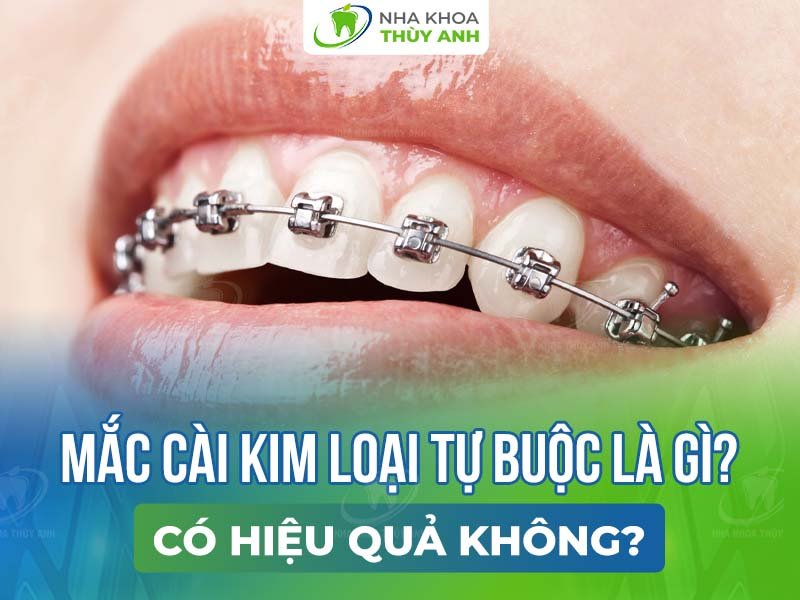 Niềng răng mắc cài kim loại tự buộc là gì? Có hiệu quả không?