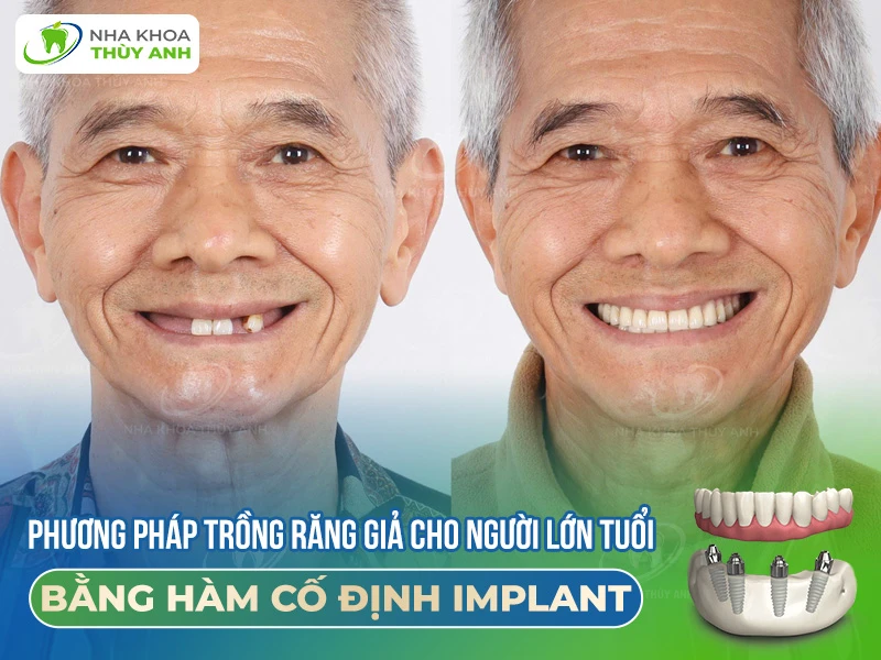 Trồng răng giả cho người lớn tuổi bằng hàm cố định implant