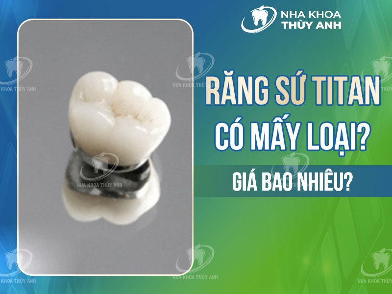 Răng sứ titan có mấy loại? 3 loại răng titan được sử dụng phổ biến