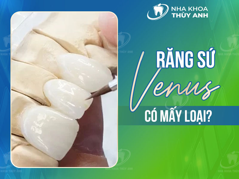 Răng sứ Venus có mấy loại? Top 5 loại sứ venus cao cấp