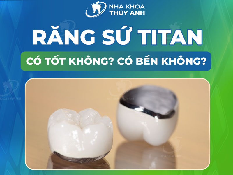 Răng sứ titan có tốt không? Bọc răng sứ titan có bền không?