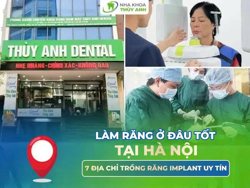 Làm răng ở đâu tốt tại Hà Nội? 7 địa chỉ trồng răng implant uy tín
