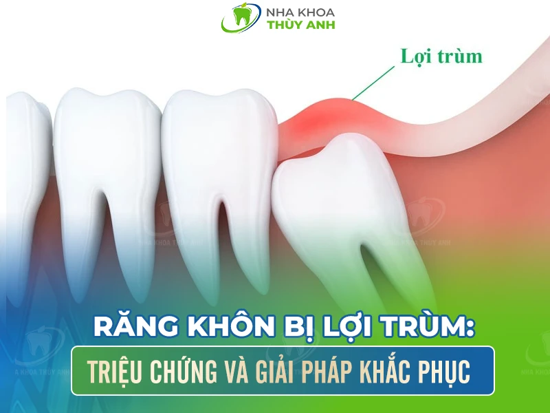 Răng khôn bị lợi trùm: Triệu chứng và giải pháp khắc phục