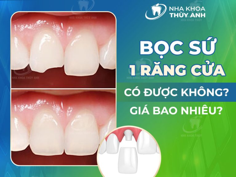 Bọc sứ 1 răng cửa được không? Giá bao nhiêu?