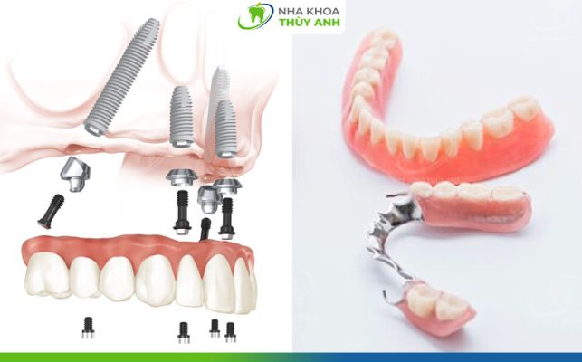 Các phương pháp làm răng giả toàn hàm phổ biến - nhakhoathuyanh