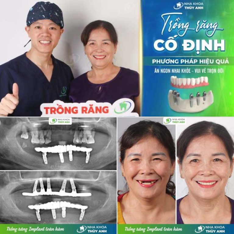 Các phương pháp làm răng giả toàn hàm phổ biến - nhakhoathuyanh