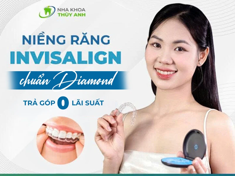 Địa chỉ niềng răng invisalign trả góp uy tín tại Hà Nội