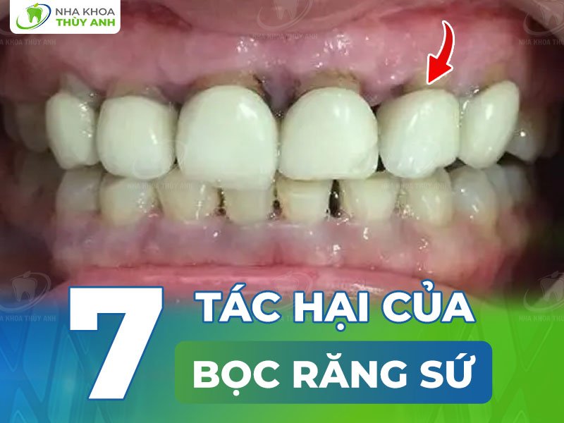 7 tác hại của bọc răng sứ và cách phòng tránh tác hại của răng sứ