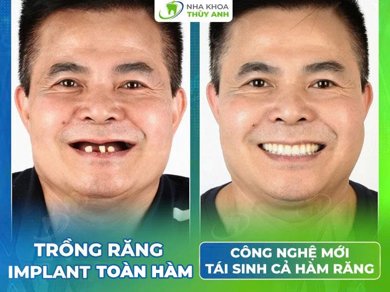 Trồng răng implant cố định toàn hàm kỹ thuật mới tái sinh cả hàm răng
