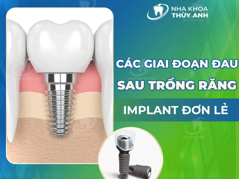 Các giai đoạn đau sau trồng răng implant đơn lẻ