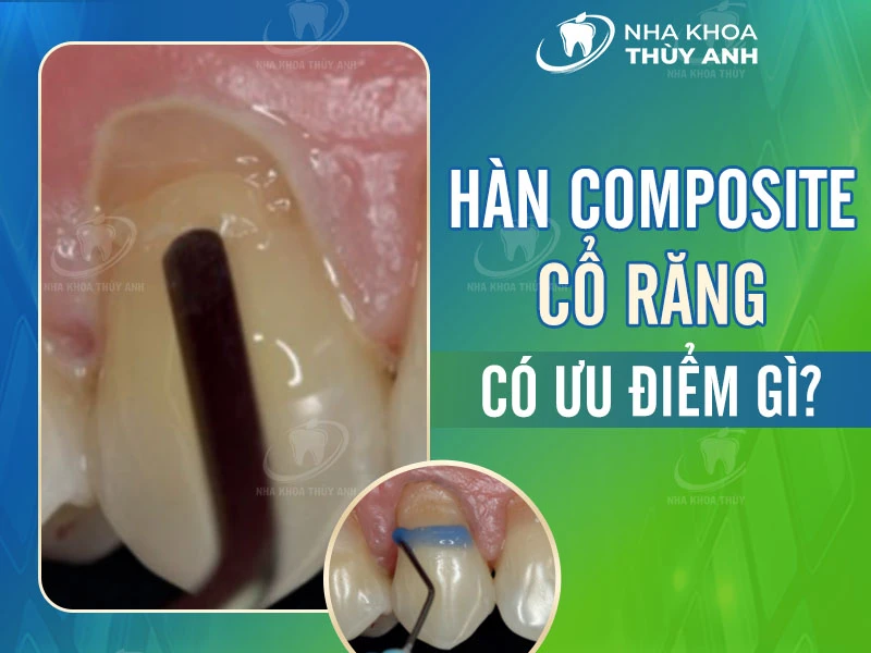 Hàn răng bằng composite có bền không?