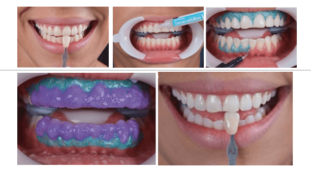 Tẩy trắng răng có những phương pháp nào? Có an toàn không?