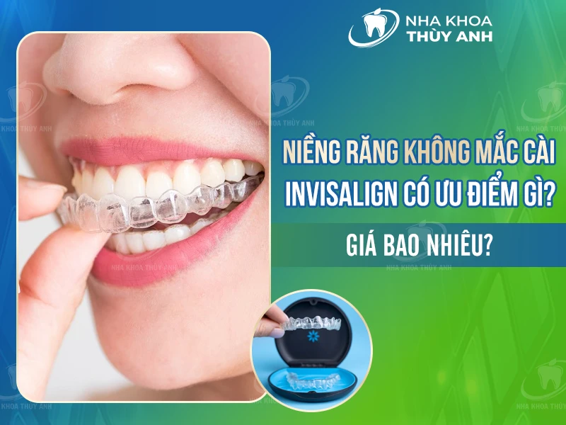 Niềng răng không mắc cài invisalign có ưu điểm gì? Giá bao nhiêu?