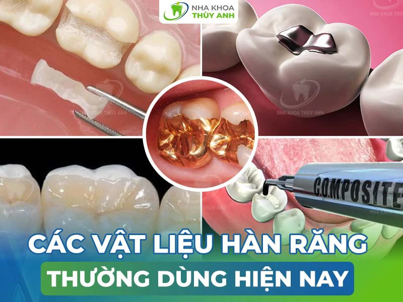 Các vật liệu hàn răng thường dùng hiện nay