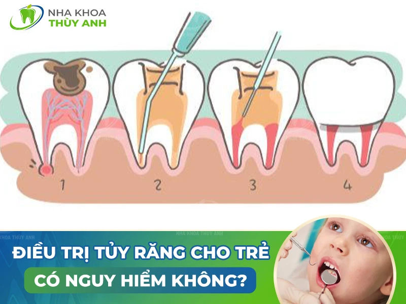 Điều trị tủy răng cho trẻ có nguy hiểm không?