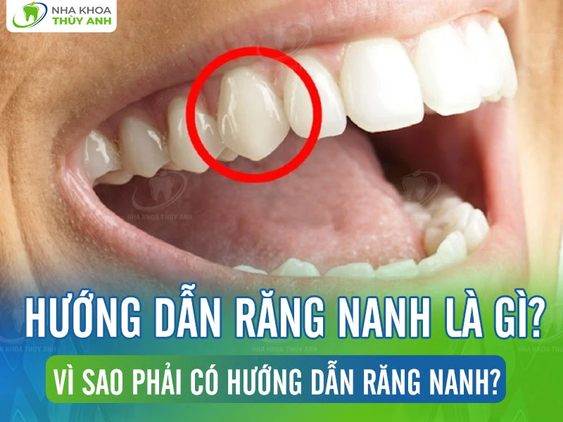 Hướng dẫn răng nanh là gì? Vì sao phải có hướng dẫn răng nanh?