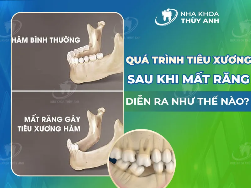 Quá trình tiêu xương sau khi mất răng diễn ra như thế nào?