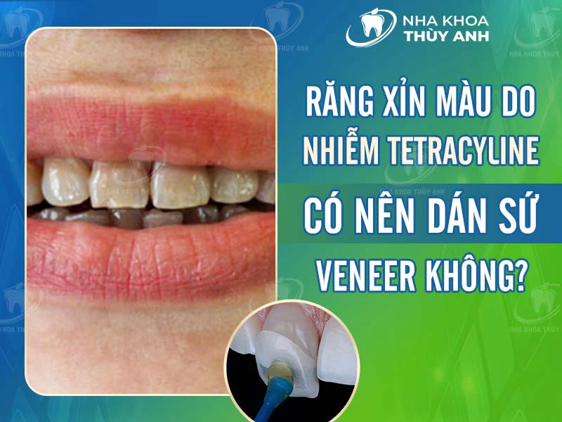 Răng xỉn màu do nhiễm tetracycline có nên dán sứ veneer không?