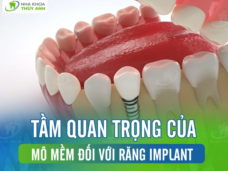 Tầm quan trọng của mô mềm đối với răng implant