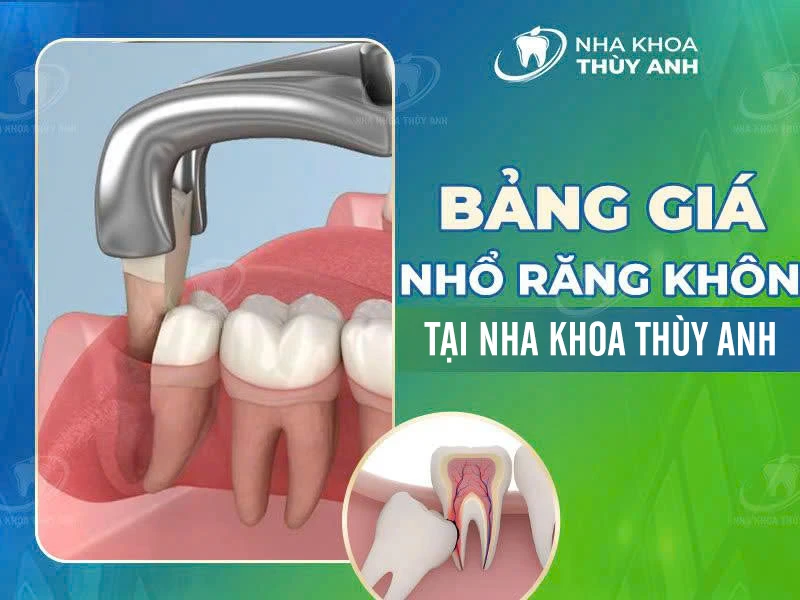 Bảng giá nhổ răng khôn cập nhật tháng 6.2026