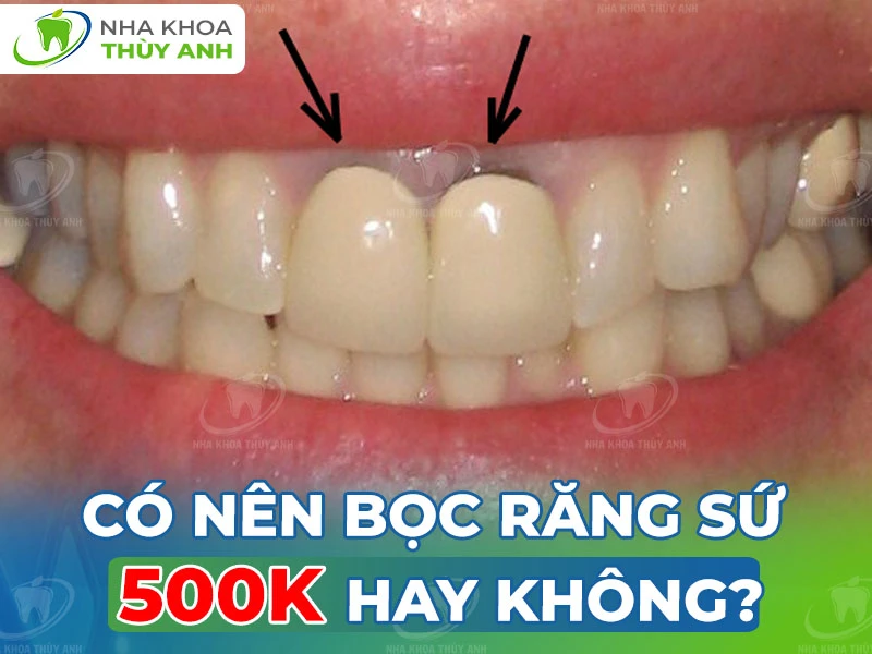 Có nên bọc răng sứ 500k không?