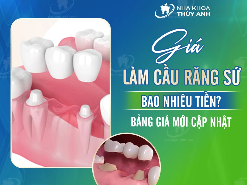 Giá làm cầu răng sứ bao nhiêu tiền? Bảng giá mới cập nhật