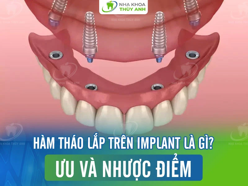 Hàm giả tháo lắp trên implant là gì? Ưu và nhược điểm