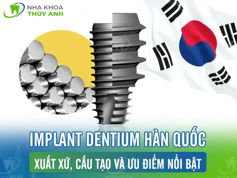 Implant Dentium Hàn Quốc: Xuất xứ, cấu tạo và ưu điểm nổi bật